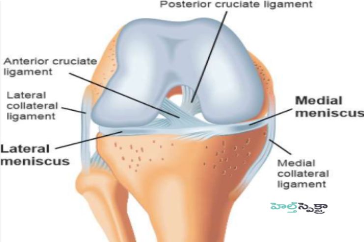 D.Chronic Degenerative Meniscal Tear