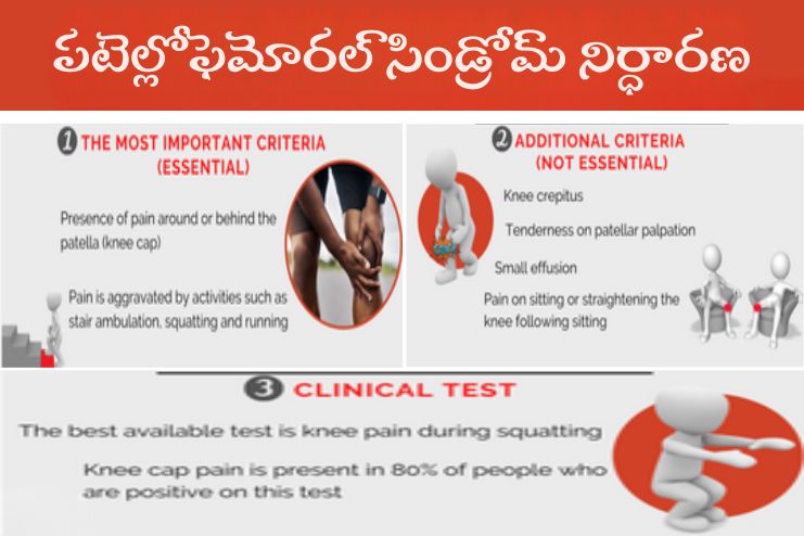 D.Patellofemoral Syndrome (PFS)