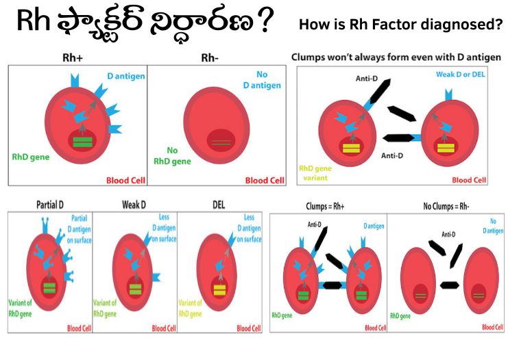 How is Rh Factor diagnosed