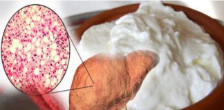 కొవ్వు కాలేయ బాధితులు పెరుగును ఆహారంలో చేర్చుకోవచ్చా? - Is Curd Safe for People with Fatty Liver Disease? Is Curd Safe for People with Fatty Liver Disease