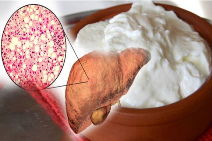 Is Curd Safe for People with Fatty Liver Disease