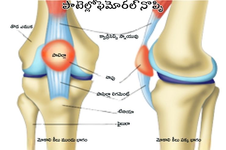 Patellofemoral Syndrome (PFS)
