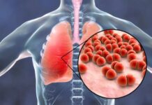 న్యుమోనియా లక్షణాలను సకాలంలో గుర్తించడం ఎలా.? Pneumonia symptoms_ early detection, proper treatment and prevention