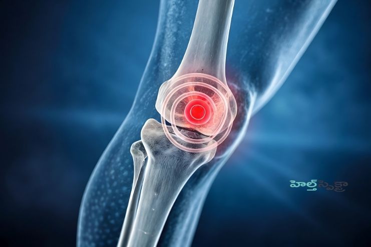 మోకాలి కార్టిలేజ్ చిరిగితే కనిపించే లక్షణాలు, చికిత్స ఇలా..! - <span class='sndtitle'></img>Torn Cartilage in the Knee: Symptoms and Treatment </span>
