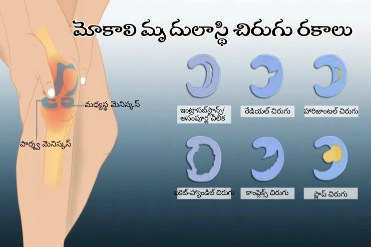 Types of Knee Cartilage Tears