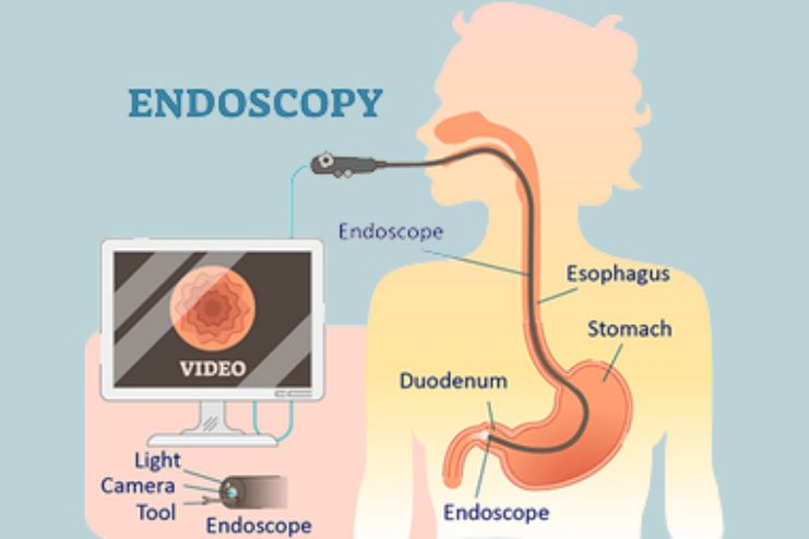What is Endoscopy