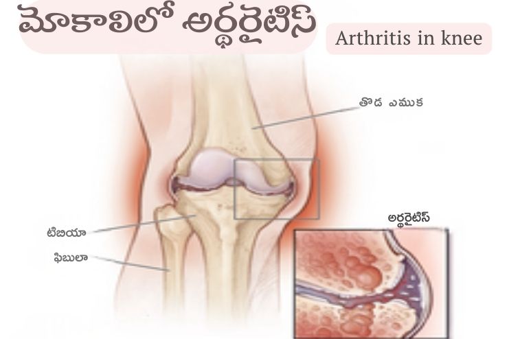 Arthritis