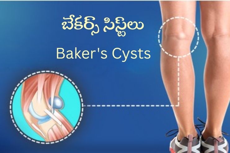 Baker's Cysts