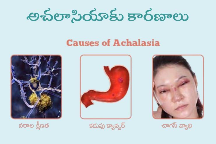 Causes of Achalasia