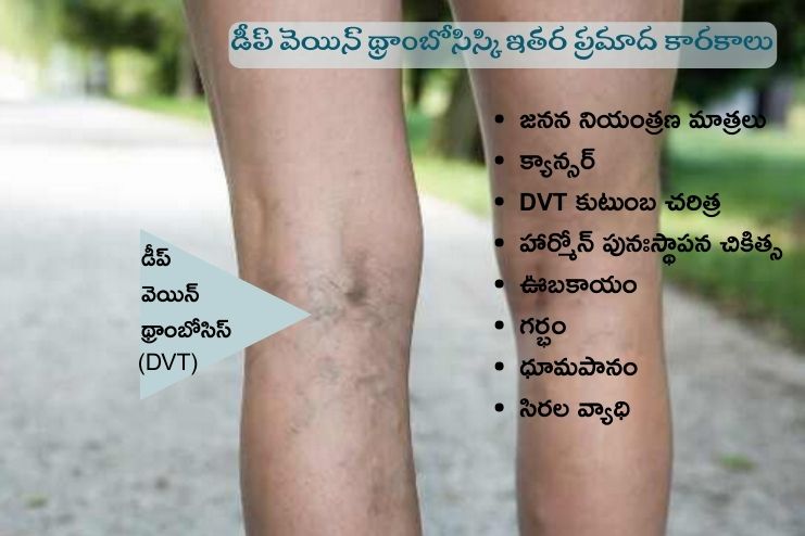 Deep Vein Thrombosis 2