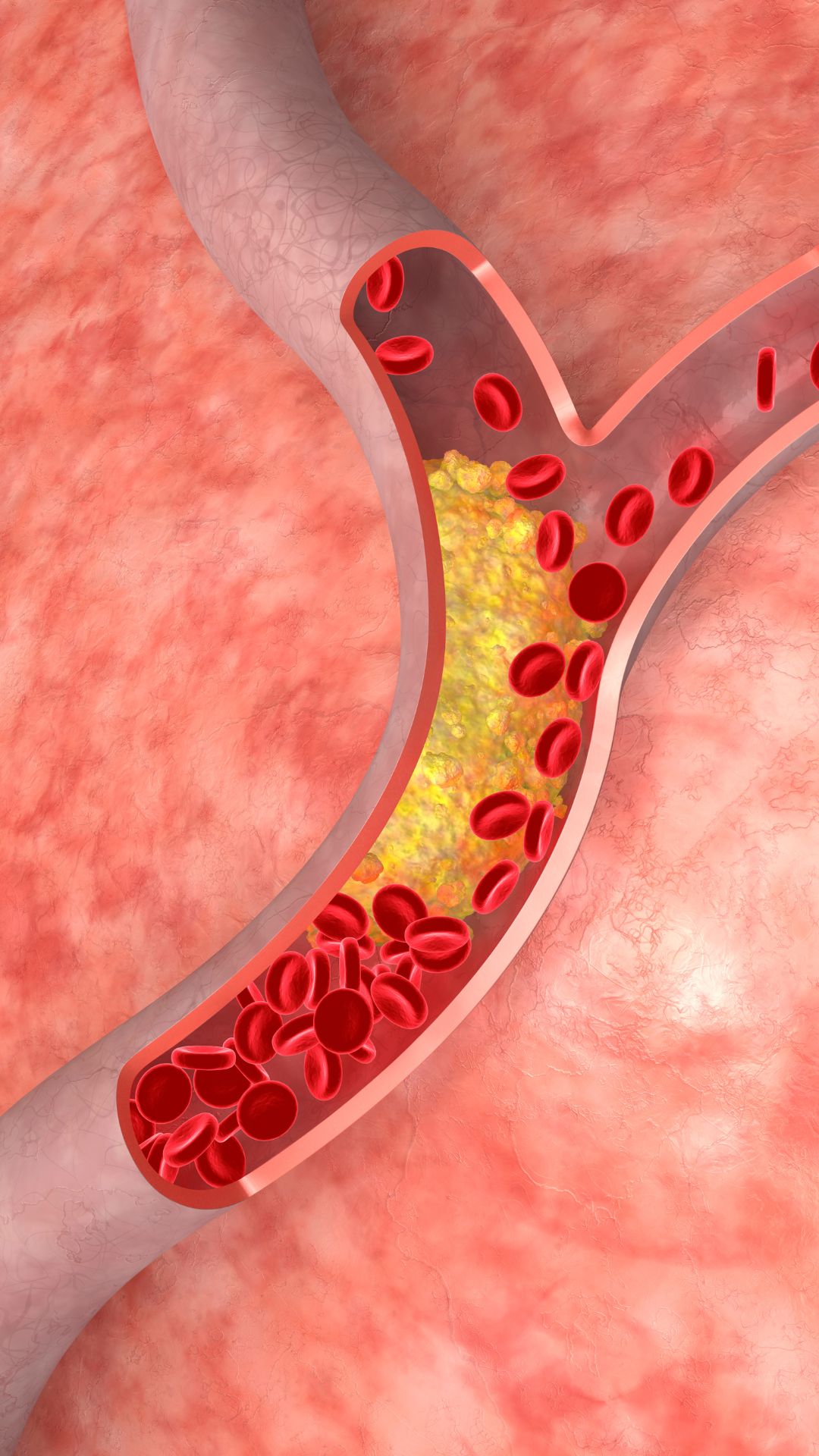 High cholesterol levels in winter