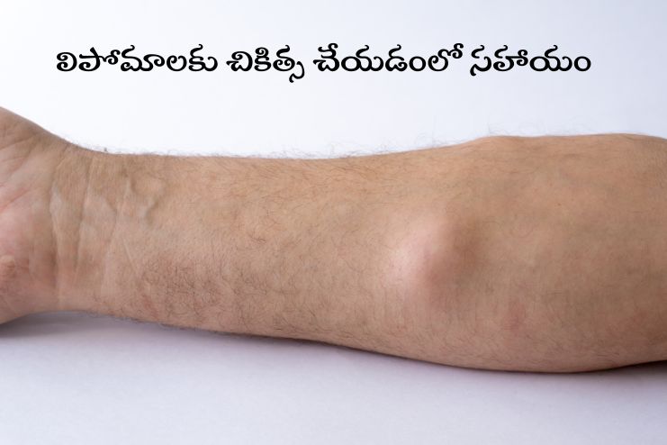 It may help treat lipomas