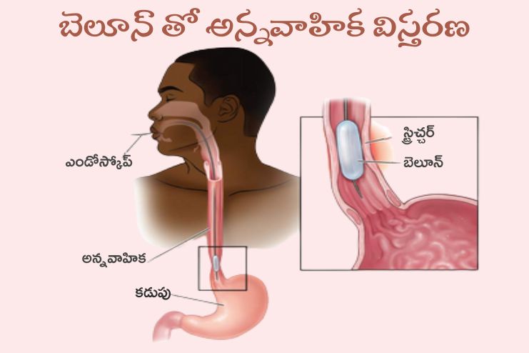Nonsurgical treatment