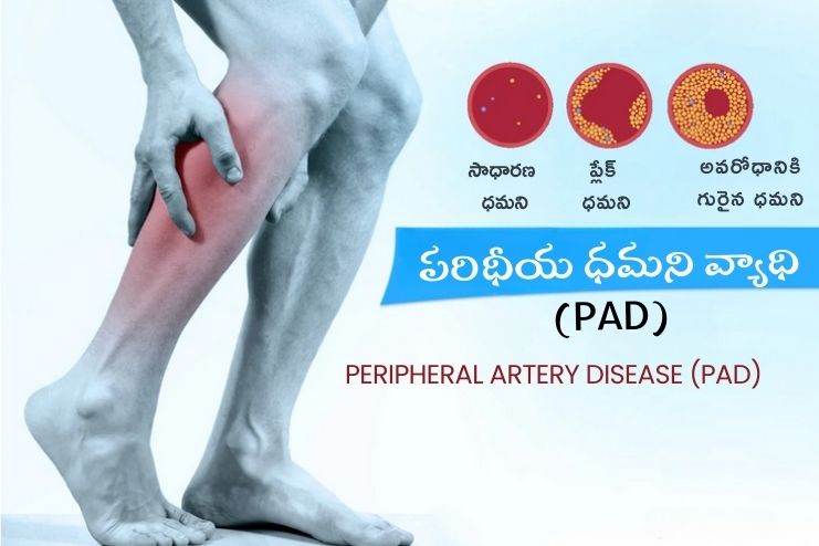 Peripheral Artery Disease