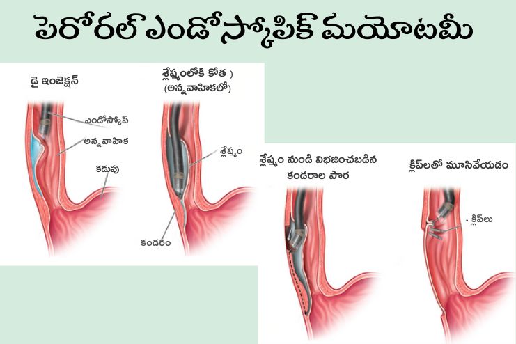Peroral endoscopic myotomy