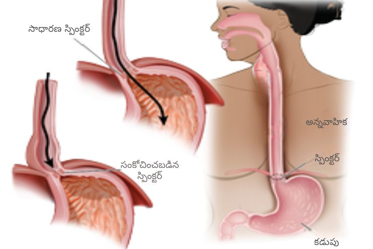 Symptoms of Achalasia 2