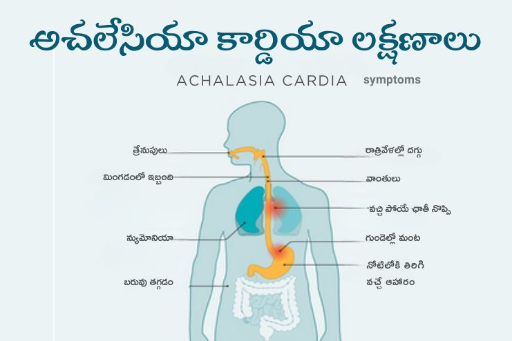 Symptoms of Achalasia