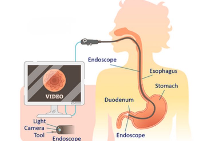 Upper endoscopy