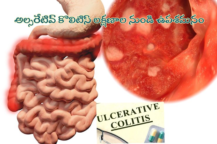 ease symptoms of ulcerative colitis