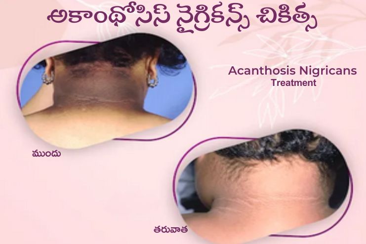 Acanthosis Nigricans Treatment