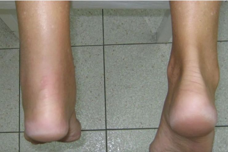 Achilles tendinitis 3