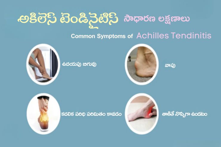 Symptoms Of Achilles tendinitis