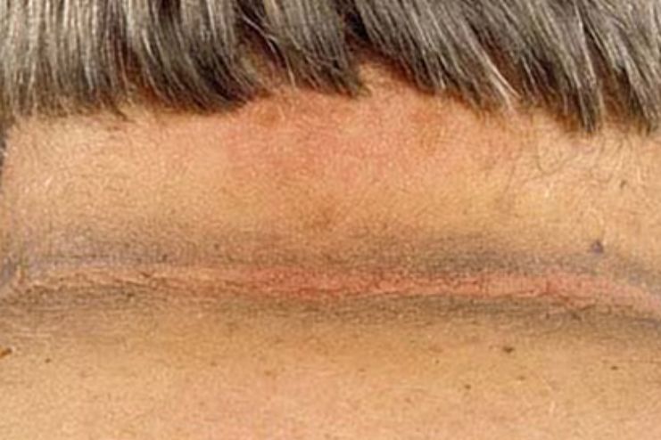 Causes and Treatment Of Acanthosis nigricans 2