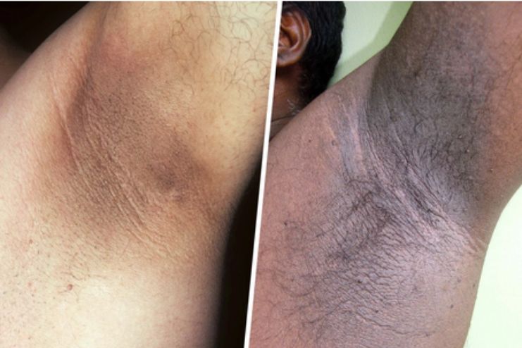 Causes and Treatment Of Acanthosis nigricans 3