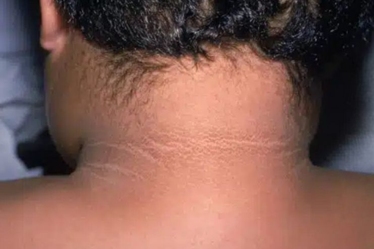 అకాంథోసిస్ నైగ్రికన్స్: కారణాలు, లక్షణాలు మరియు చికిత్స - <span class='sndtitle'></img>Acanthosis nigricans: Causes, Symptoms and Treatment </span>