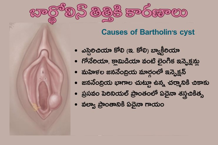 Causes of Bartholin's cyst