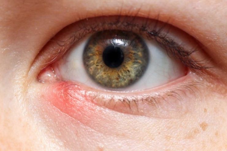 How is a stye diagnosed