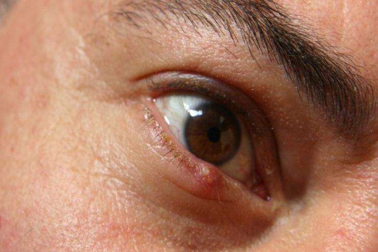 How to identify a stye