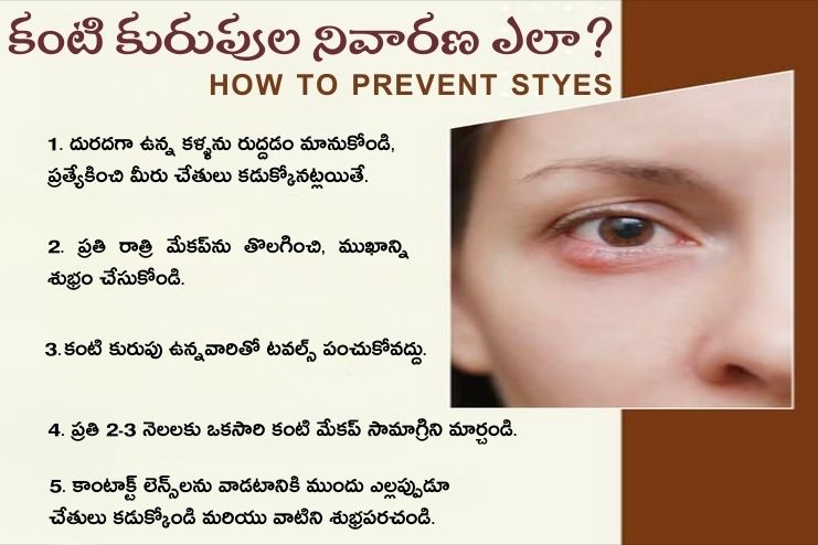 How to prevent styes