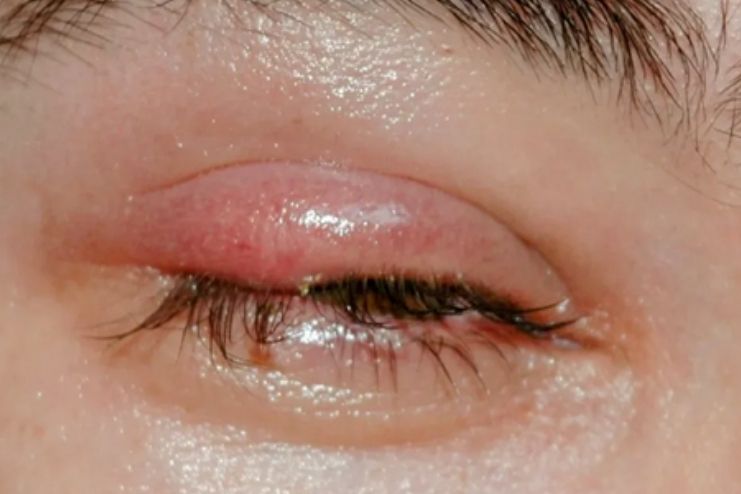 How to treat a stye