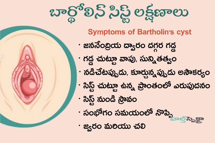 Symptoms of Bartholin's cyst