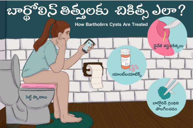 Treatment for Bartholin's cyst