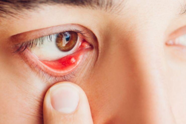 What exactly is a stye