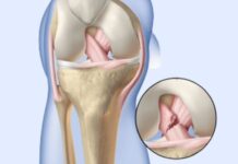 ఎసిఎల్ గాయం: కారణాలు, లక్షణాలు మరియు చికిత్స acl tear