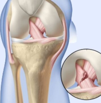 ఎసిఎల్ గాయం: కారణాలు, లక్షణాలు మరియు చికిత్స acl tear