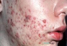 మొటిమలు: కారణాలు, లక్షణాలు మరియు చికిత్స Acne_ Causes, Symptoms and Treatment