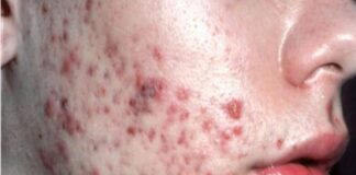 మొటిమలు: కారణాలు, లక్షణాలు మరియు చికిత్స - Acne: Causes, Symptoms and Treatment Acne_ Causes, Symptoms and Treatment
