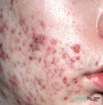 మొటిమలు: కారణాలు, లక్షణాలు మరియు చికిత్స Acne_ Causes, Symptoms and Treatment