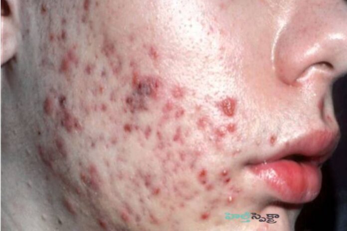 Acne_ Causes, Symptoms and Treatment