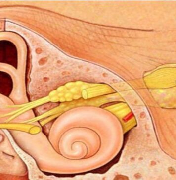 అకౌస్టిక్ న్యూరోమా: కారణాలు, లక్షణాలు మరియు చికిత్స Acoustic Neuroma_ Symptoms, Causes, and Treatment
