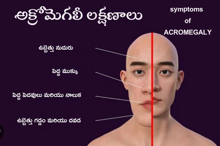 Acromegaly symptoms