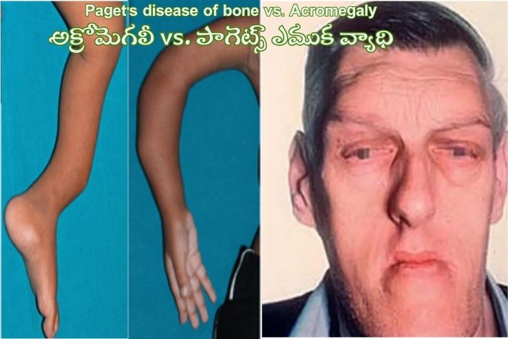 Acromegaly vs. Paget's disease of bone