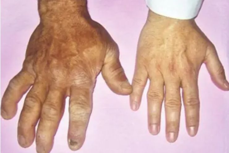 Acromegaly_ Causes, Symptoms and Treatment 2