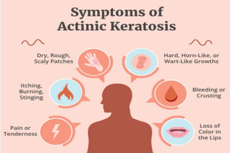 Actinic keratoses Symptoms