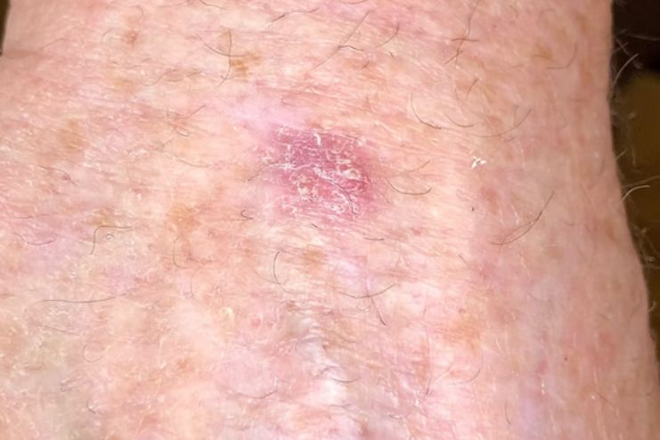 Actinic keratosis 2