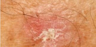 ఆక్టినిక్ కెరాటోసిస్: కారణాలు, లక్షణాలు మరియు చికిత్స - Actinic keratosis: Causes, Symptoms and treatment Actinic keratosis